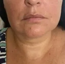 Mesma aluna no acompanhamento, região: Papada