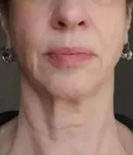 Aluna no início, região: Pescoço