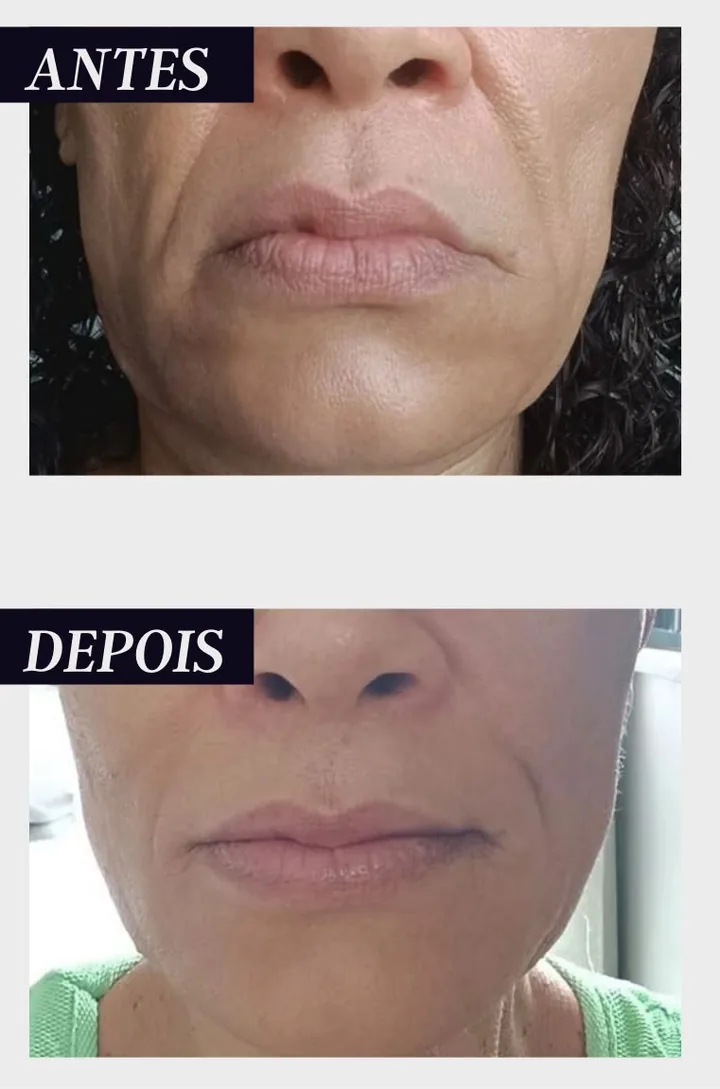 Antes e depois de aluna: região da boca e bigode chinês