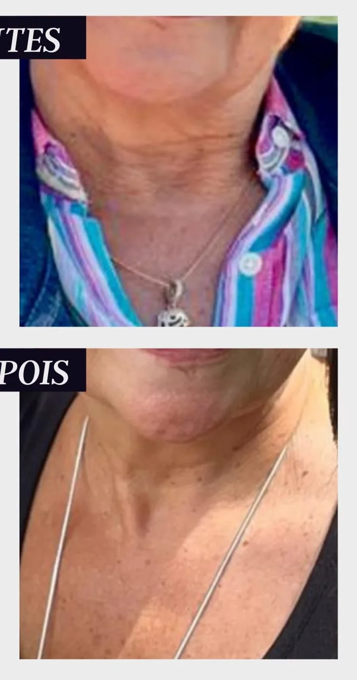 Antes e depois de aluna: pescoço
