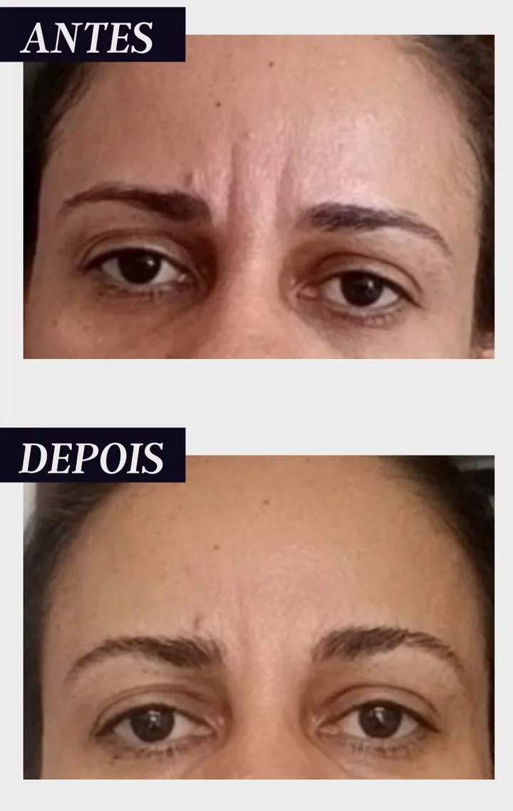 Antes e depois de aluna: testa e região entre as sobrancelhas